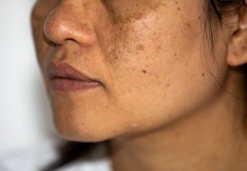 melasma viso