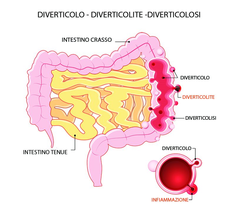 Diverticolo, Diverticolite e Diverticolisi