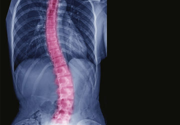 scoliosi lombare destro convessa