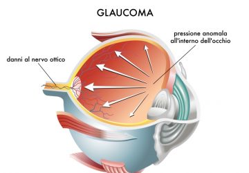 Glaucoma