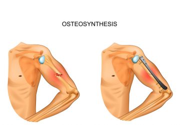 osteosintesi