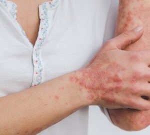 Psoriasi