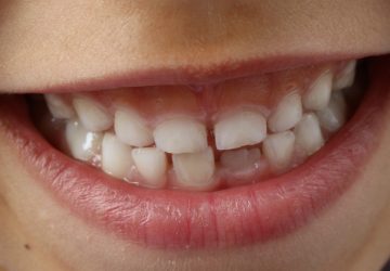 Bambini denti