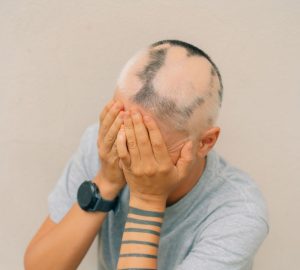 ragazzo con alopecia areata