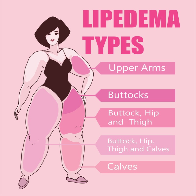 disegno di una donna con lipedema e spiegazioni in inglese